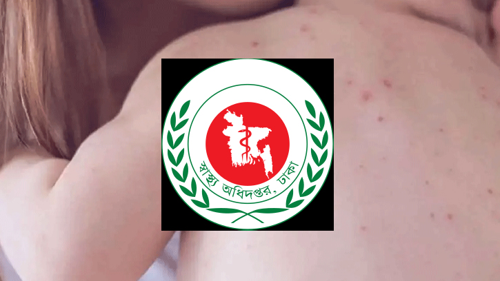 হামের উপসর্গে ২৪ ঘণ্টায় ৫ শিশুর মৃত্যু