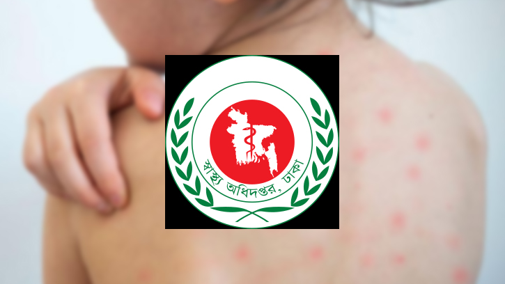 নতুন করে ৫ প্রাণহানি, বাড়ছে হাম সংক্রমণ
