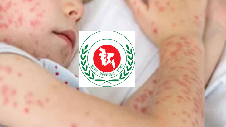 ২৪ ঘণ্টায় হাম ও উপসর্গে প্রাণ গেল ১১ শিশুর