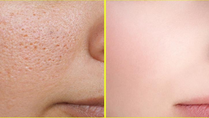 লোমকূপ বা ‘পোরস’ কি আসলেই বন্ধ করা সম্ভব