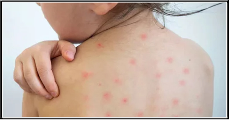 শিশুদের হাম হলে বাসায় করণীয় ও সতর্কতা