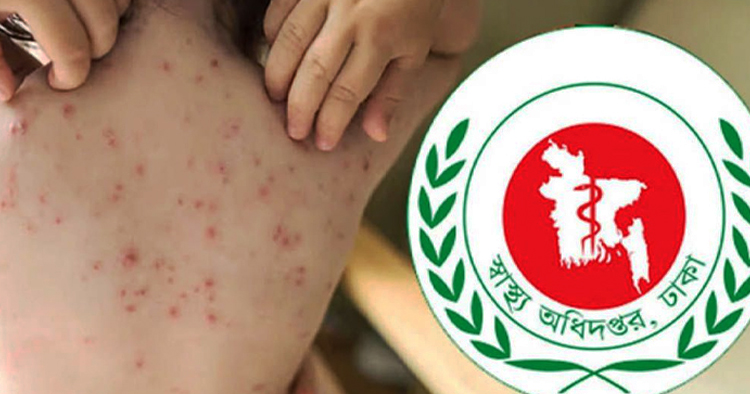 হামের উপসর্গে আরও ২ জনের মৃত্যু, প্রাণহানি বেড়ে ৫৮৫