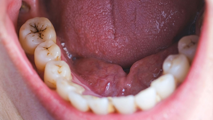 মুখে ক্যানসারের ঝুঁকি বাড়াচ্ছে দাঁতের ক্ষয়