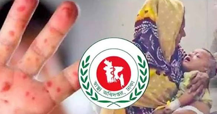 হামের উপসর্গে আরও ২ শিশুর মৃত্যু, নতুন রোগী ১,২৯৭