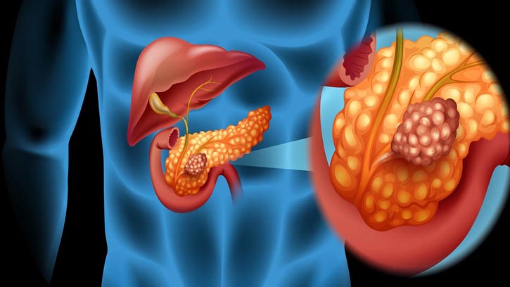 প্যানক্রিয়াটিক ক্যানসার: লক্ষণ ও সাবধানতার উপায়