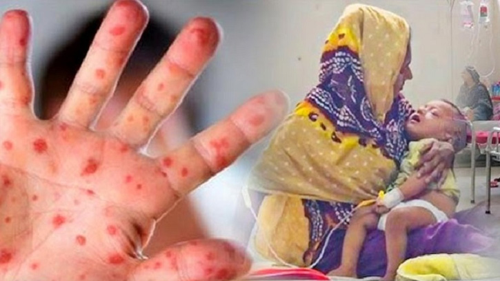 সারাদেশে হাম ও হামের উপসর্গে ৪ জনের মৃত্যু