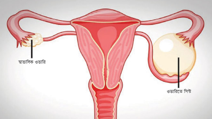 মহিলাদের জন্য সতর্কবার্তা: সিস্ট নয়, ক্যানসারও হতে পারে