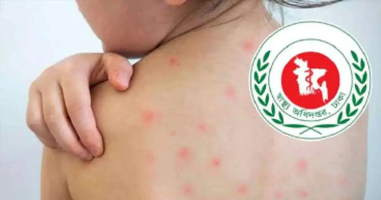 হাম ও উপসর্গে আরও ২ মৃত্যু, মোট মৃত ১ হাজার ১৬৪