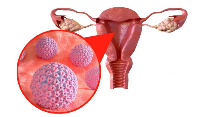 জরায়ুমুখ ক্যান্সার: কারণ, লক্ষণ ও প্রতিরোধ