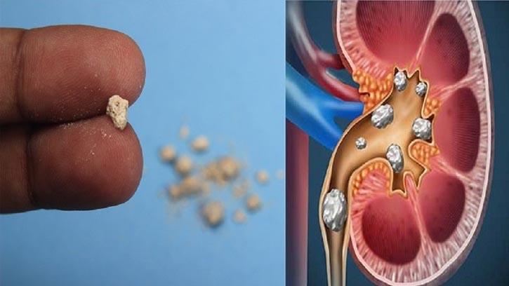 অতিরিক্ত অ্যান্টিবায়োটিক খেলে কিডনিতে পাথর জমার ঝুঁকি বৃদ্ধি