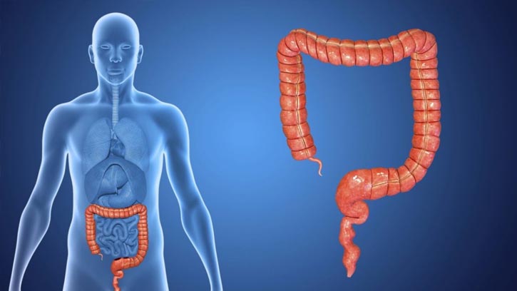 কোলোরেক্টাল ক্যানসারের প্রাথমিক ৪টি লক্ষণ যা এড়িয়ে যাবেন না!