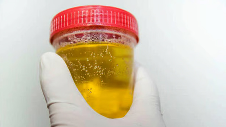 মূত্রে ফেনার কারণ ও করণীয় কী