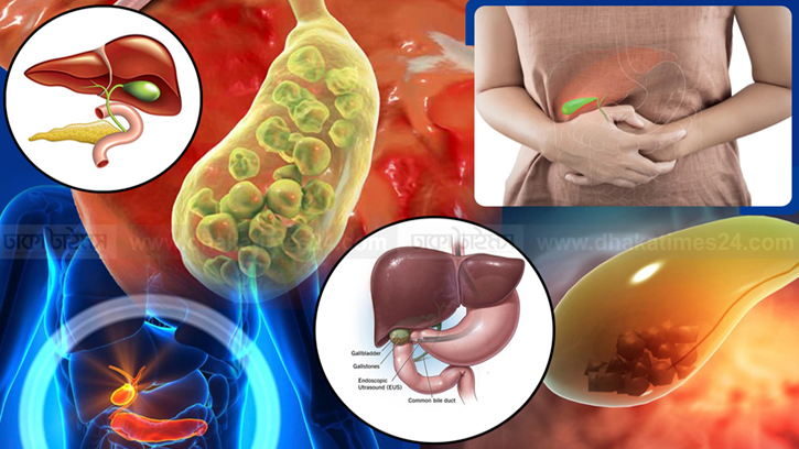 পিত্তথলিতে পাথর: যা জানা জরুরি