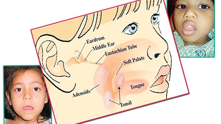 শিশুর শ্বাসকষ্টে সতর্ক হোন, হতে পারে অ্যাডেনয়েড বৃদ্ধি