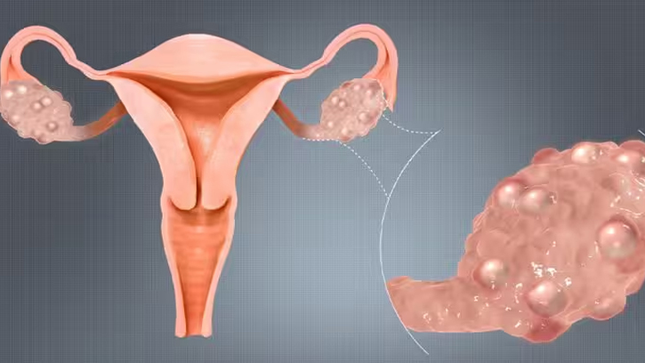 ওভারির সিস্ট কমাতে কার্যকর ১৫ প্রাকৃতিক উপায়