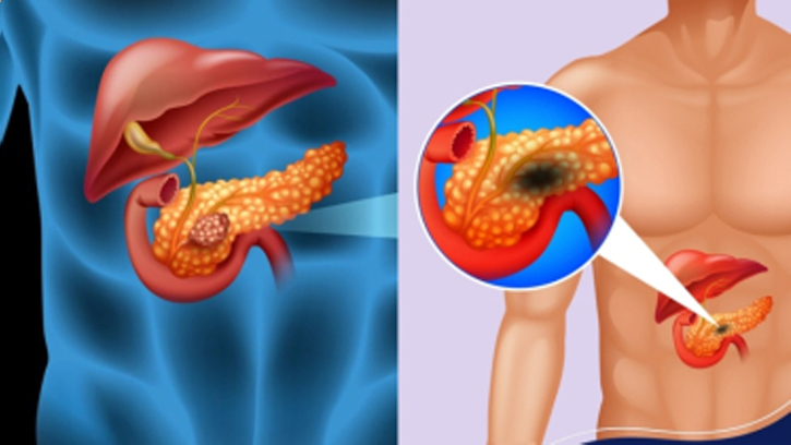 জেনে নিন ক্যান্সারের ৭টি নিঃশব্দ সতর্ক সংকেত