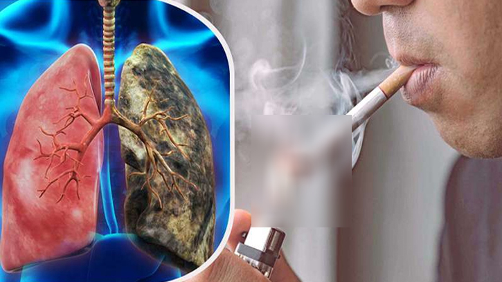 ধূমপান ছাড়াও কেন অল্প বয়সীদের মধ্যে বাড়ছে ফুসফুস ক্যান্সার