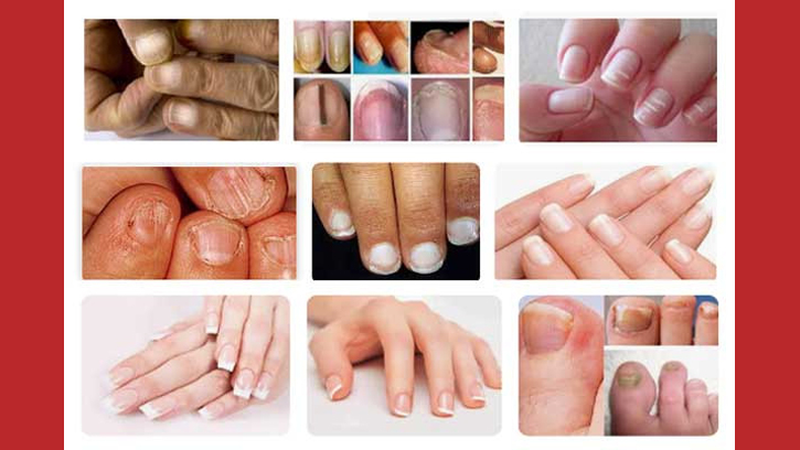 নখের গঠন ও রঙে বোঝা যায় রোগের লক্ষণ