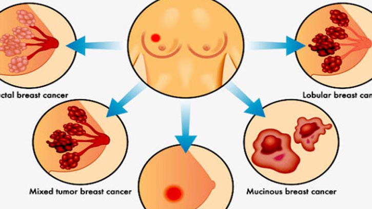 লজ্জা কাটিয়ে সচেতন হোন; স্তন ক্যান্সারের লক্ষণ ও প্রতিকার
