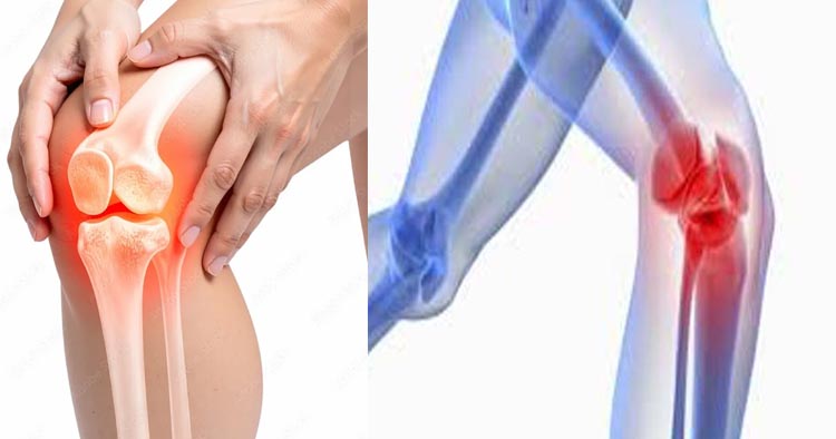 হাঁটুর ব্যথা ও আর্থ্রাইটিস: কেন নারীরা পুরুষের তুলনায় বেশি ভোগেন