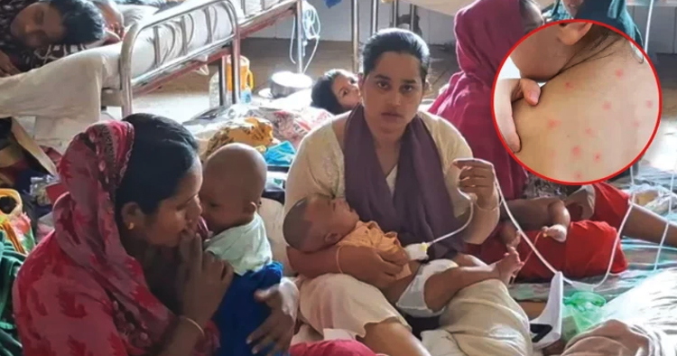 হাম-হামের উপসর্গে একদিনে ৬ শিশুর মৃত্যু, মোট প্রাণহানি ৯৭৯