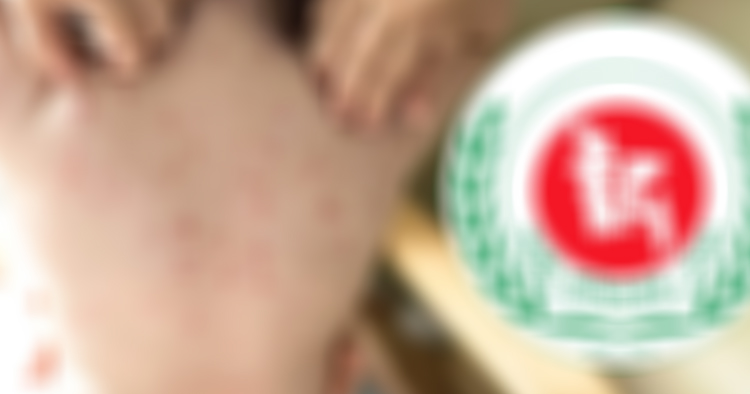 হামের উপসর্গে আরও ৬ শিশুর মৃত্যু, মোট প্রাণহানি ৭০৮
